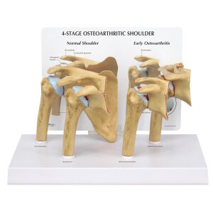 Osteoarthritis (OA) Schultermodell in 4 Stadien