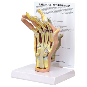 Handmodell mit rheumatoider Arthritis